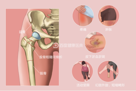 顺德和平骨科医院 89岁高龄患者面对“人生最后一次骨折”，保守&手术该如何抉择？