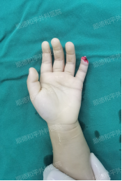 指尖上的“生死时速”——顺德和平外科医院3岁男童断指再植纪实 指尖上的“生死时速”——顺德和平外科医院3岁男童断指再植纪实