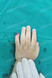 指尖上的“生死时速”——顺德和平外科医院3岁男童断指再植纪实 指尖上的“生死时速”——顺德和平外科医院3岁男童断指再植纪实