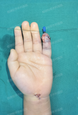 指尖上的“生死时速”——顺德和平外科医院3岁男童断指再植纪实 指尖上的“生死时速”——顺德和平外科医院3岁男童断指再植纪实