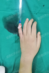 指尖上的“生死时速”——顺德和平外科医院3岁男童断指再植纪实 指尖上的“生死时速”——顺德和平外科医院3岁男童断指再植纪实