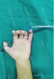 指尖上的“生死时速”——顺德和平外科医院3岁男童断指再植纪实 指尖上的“生死时速”——顺德和平外科医院3岁男童断指再植纪实